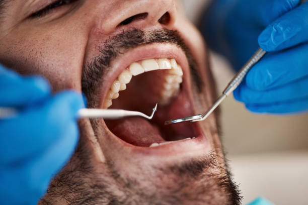 Best Emergency Dentist for Knocked-Out Tooth in Palmer Ranch, FL